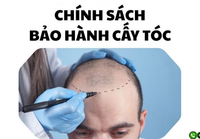 Chính sách bảo hành cấy tóc lâu dài tại Viện Cấy tóc Quốc tế – Đầu tư 1 lần, yên tâm cả đời
