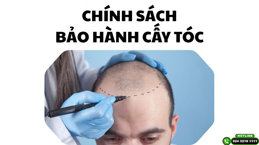 Chính sách bảo hành cấy tóc lâu dài tại Viện Cấy tóc Quốc tế – Đầu tư 1 lần, yên tâm cả đời