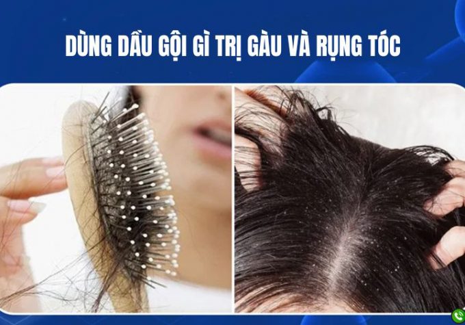 Dùng dầu gội gì trị gàu và rụng tóc hiệu quả – Chuyên gia chia sẻ