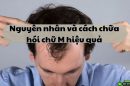 Nguyên nhân và cách chữa hói chữ M hiệu quả mà nam giới nên biết