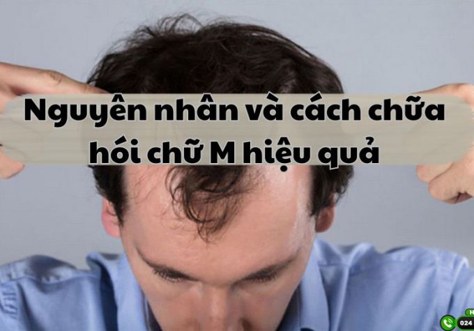 Nguyên nhân và cách chữa hói chữ M hiệu quả mà nam giới nên biết