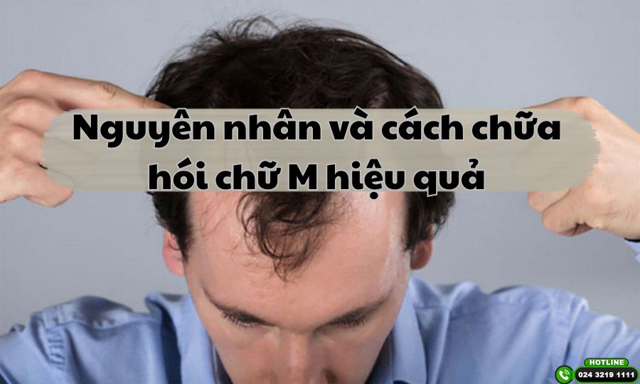 Nguyên nhân và cách chữa hói chữ M hiệu quả mà nam giới nên biết