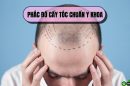 Giải mã phác đồ cấy tóc chuẩn y khoa: Bí quyết phục hồi tóc toàn diện