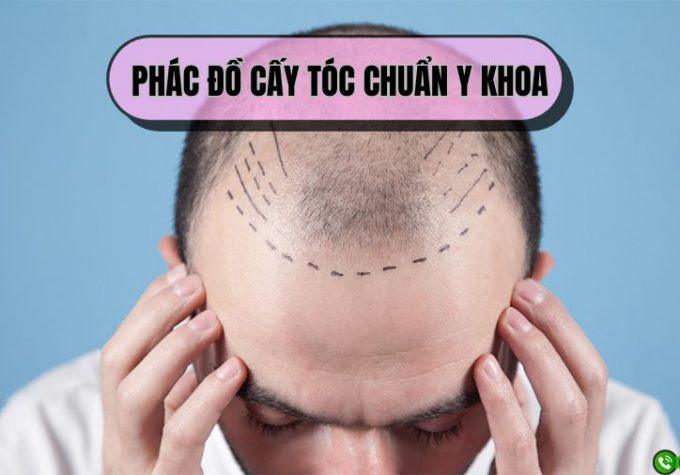 Giải mã phác đồ cấy tóc chuẩn y khoa: Bí quyết phục hồi tóc toàn diện