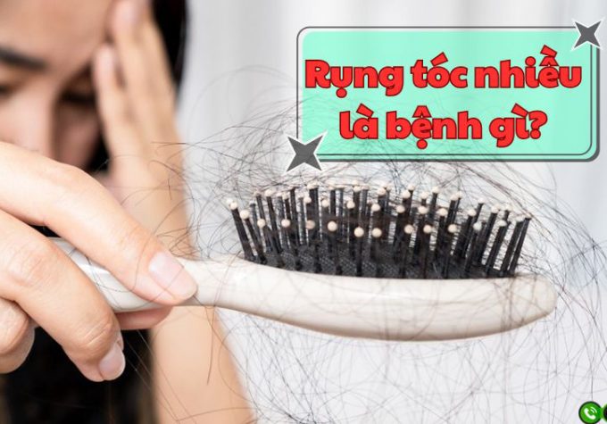 Chuyên gia giải đáp: Rụng tóc nhiều bị bệnh gì?