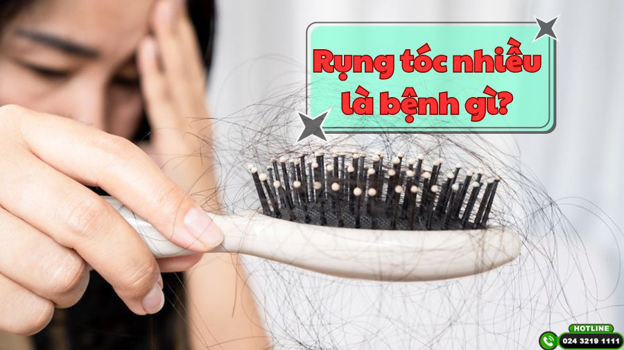 Chuyên gia giải đáp: Rụng tóc nhiều bị bệnh gì?