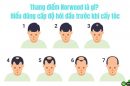 Thang điểm Norwood là gì? Hiểu đúng cấp độ hói đầu trước khi cấy tóc