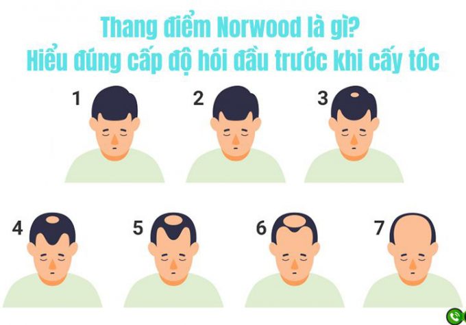 Thang điểm Norwood là gì? Hiểu đúng cấp độ hói đầu trước khi cấy tóc