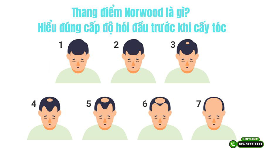Thang điểm Norwood là gì? Hiểu đúng cấp độ hói đầu trước khi cấy tóc