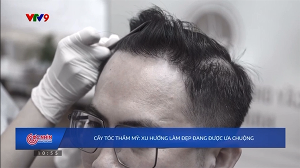 cấy tóc trị hói