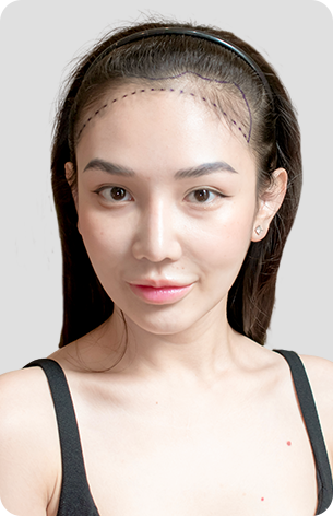 cấy tóc trị hói