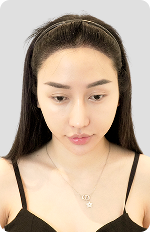 cấy tóc trị hói