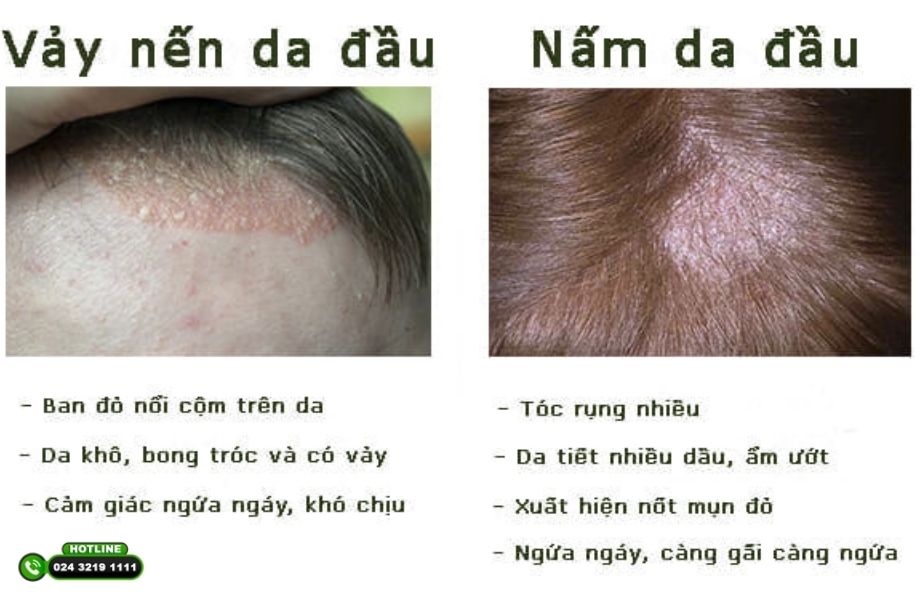 Tóc gàu và ngứa đỏ: Nguyên nhân và hướng xử lý hiệu quả 