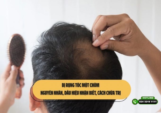 Bị rụng tóc một chòm: Nguyên nhân, dấu hiệu nhận biết, cách chữa trị