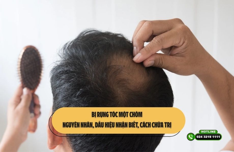 Bị rụng tóc một chòm: Nguyên nhân, dấu hiệu nhận biết, cách chữa trị