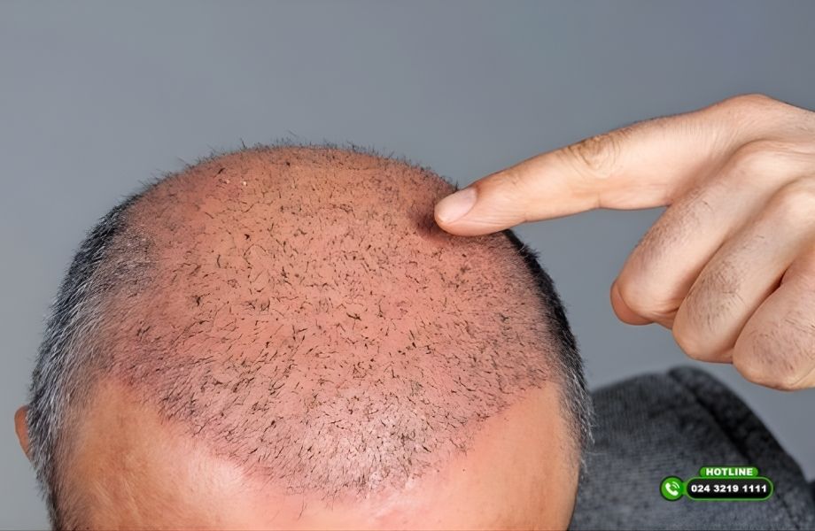 Cảnh báo khách hàng: Cẩn thận khi cấy tóc Thượng Hải đang tràn lan tại Việt Nam