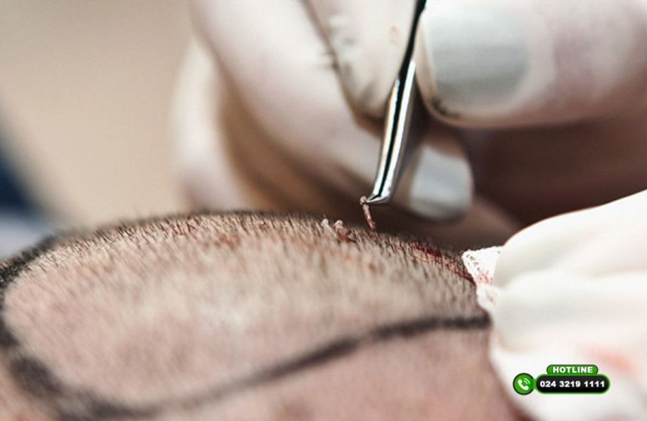 So sánh cấy tóc truyền thống và cấy tóc robot dưới góc nhìn chuyên môn