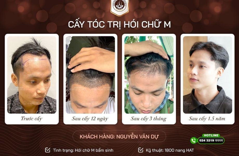 Thời gian phục hồi sau cấy tóc mất bao lâu? Phân tích từ chuyên gia