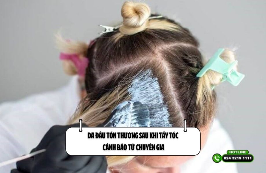 Da đầu tổn thương sau khi tẩy tóc: Cảnh báo từ chuyên gia