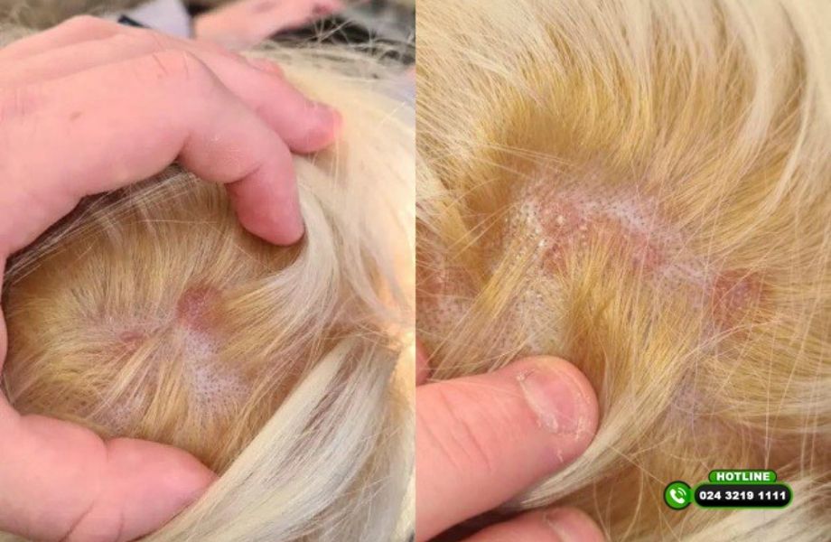 Da đầu tổn thương sau khi tẩy tóc: Cảnh báo từ chuyên gia