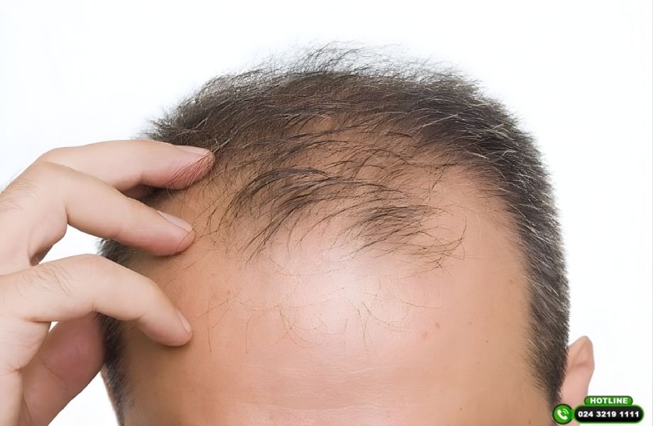Rụng tóc DHT là gì? Vì sao càng điều trị muộn tóc càng khó mọc lại?