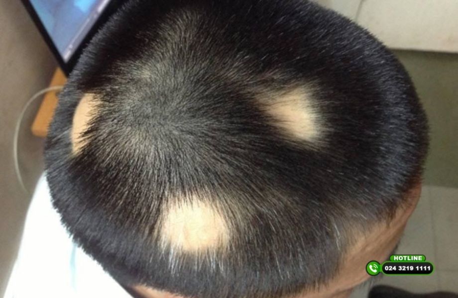 Bị rụng tóc một chòm: Nguyên nhân, dấu hiệu nhận biết, cách chữa trị