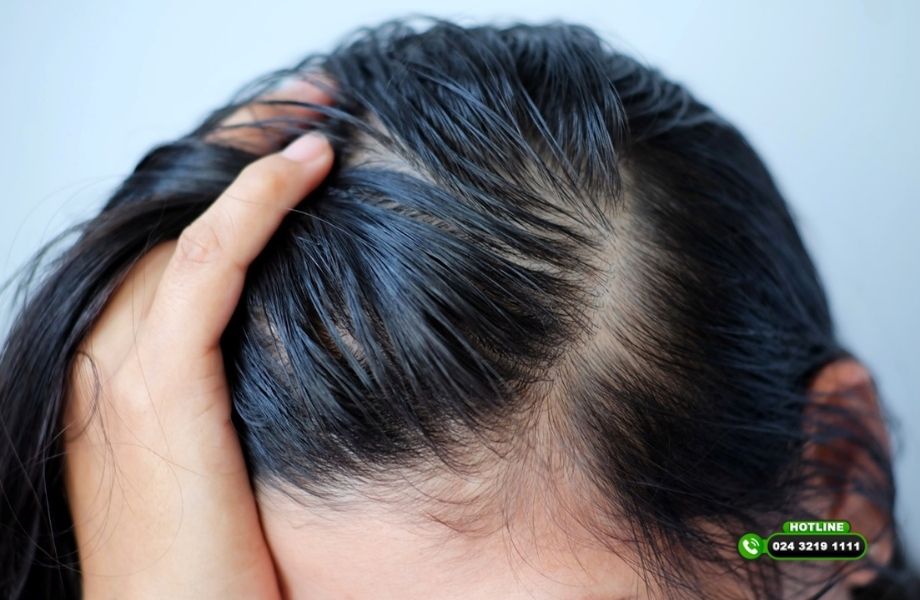 Những dấu hiệu cho thấy bạn bị rụng tóc nghiêm trọng và cần can thiệp sớm