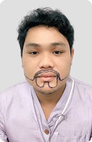 cấy tóc trị hói