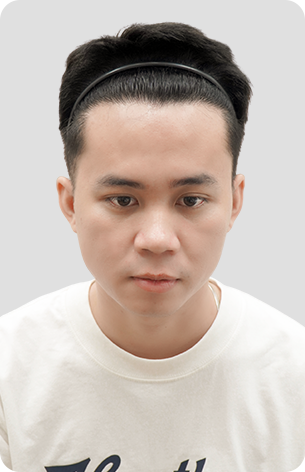 cấy tóc trị hói