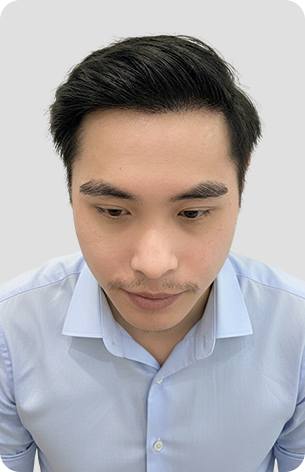 cấy tóc trị hói