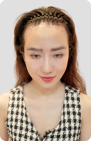 cấy tóc trị hói