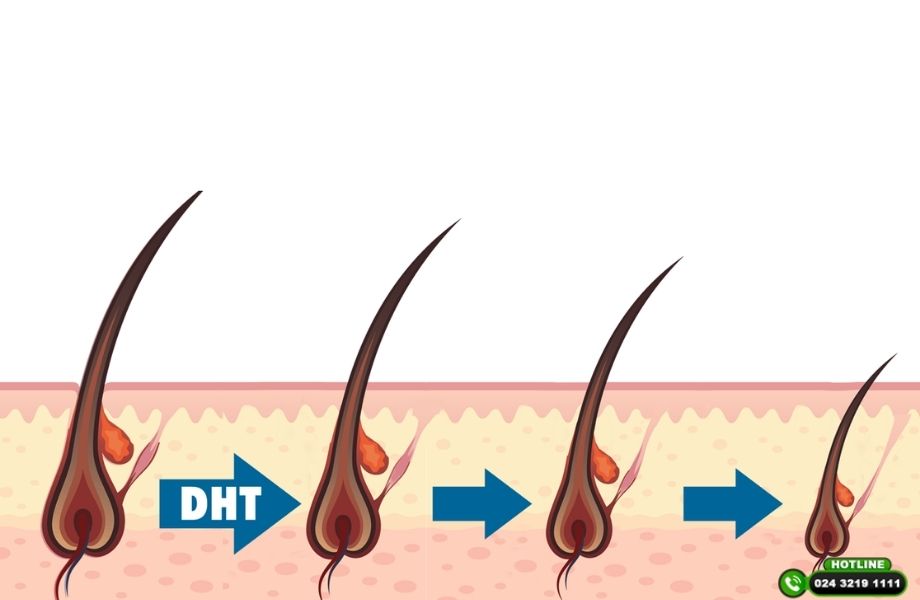 Rụng tóc DHT là gì? Vì sao càng điều trị muộn tóc càng khó mọc lại?