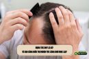 Rụng tóc DHT là gì? Vì sao càng điều trị muộn tóc càng khó mọc lại?