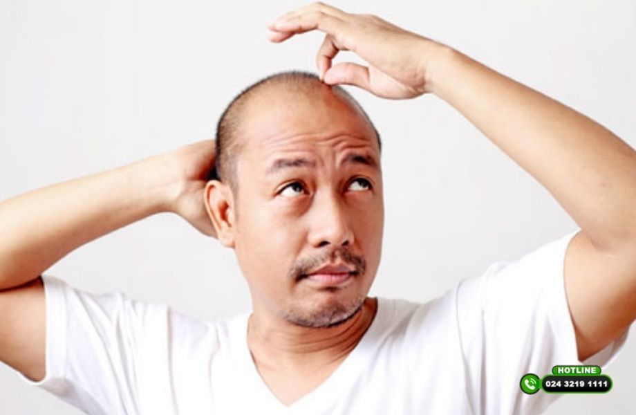 Điểm mặt các lí do dẫn tới rụng tóc phổ biến nhất