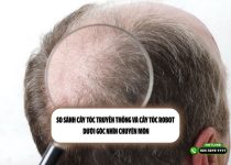 So sánh cấy tóc truyền thống và cấy tóc robot dưới góc nhìn chuyên môn
