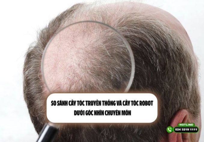 So sánh cấy tóc truyền thống và cấy tóc robot dưới góc nhìn chuyên môn