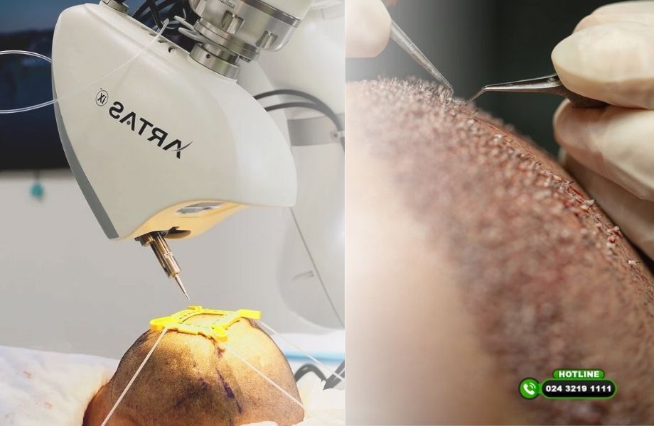 So sánh cấy tóc truyền thống và cấy tóc robot dưới góc nhìn chuyên môn