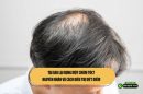 Tại sao lại rụng một chỏm tóc? Nguyên nhân và cách điều trị dứt điểm 