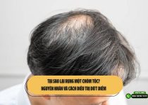 Tại sao lại rụng một chỏm tóc? Nguyên nhân và cách điều trị dứt điểm 