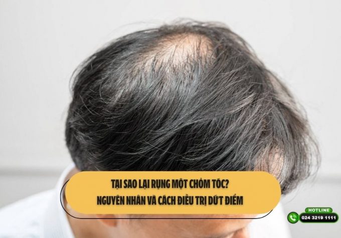 Tại sao lại rụng một chỏm tóc? Nguyên nhân và cách điều trị dứt điểm 