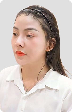 cấy tóc trị hói