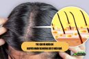 Tóc gàu và ngứa đỏ: Nguyên nhân và hướng xử lý hiệu quả 