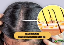 Tóc gàu và ngứa đỏ: Nguyên nhân và hướng xử lý hiệu quả 