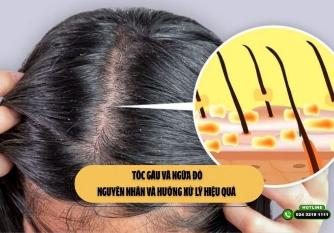 Tóc gàu và ngứa đỏ: Nguyên nhân và hướng xử lý hiệu quả 