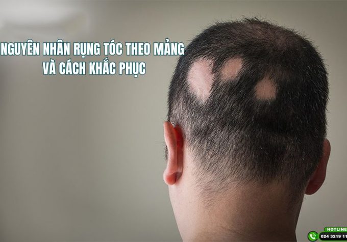 7 Nguyên nhân rụng tóc theo mảng mà bạn cần chú ý