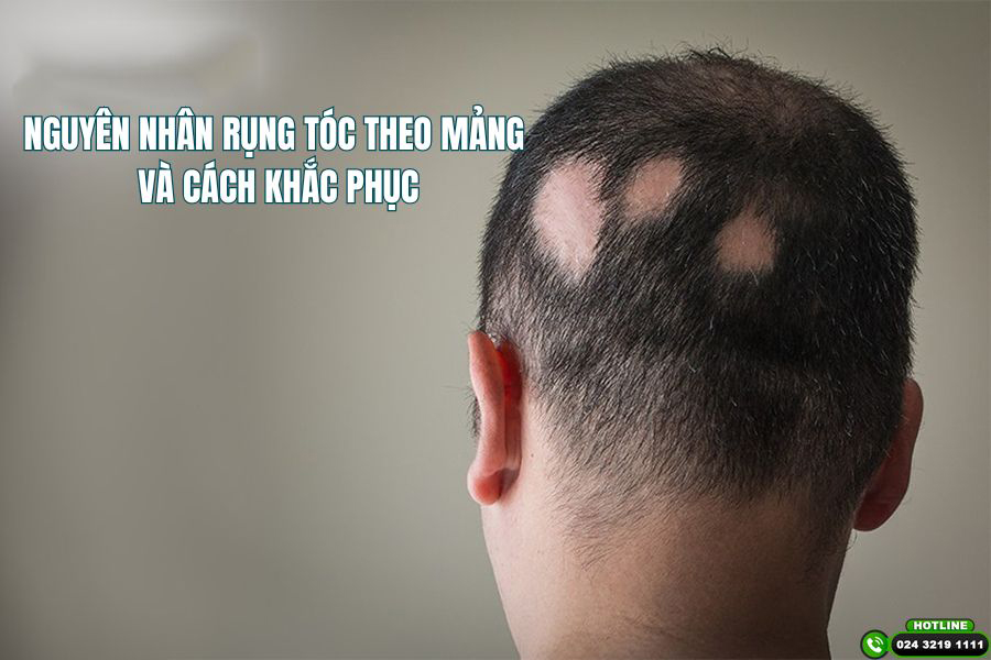 7 Nguyên nhân rụng tóc theo mảng mà bạn cần chú ý