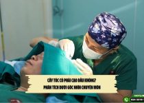 Cấy tóc có phải cạo đầu không? Phân tích dưới góc nhìn chuyên môn