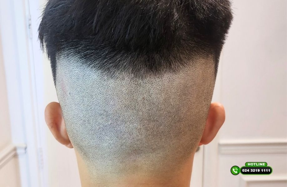 Cấy tóc có phải cạo đầu không? Phân tích dưới góc nhìn chuyên môn
