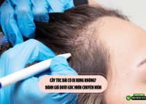 Cấy tóc dài có bị rụng không? Đánh giá dưới góc nhìn chuyên môn