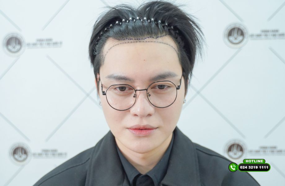 Khi hot TikTok Cường Jin cấy tóc hói chữ M: Trải nghiệm thực tế từ người trong cuộc